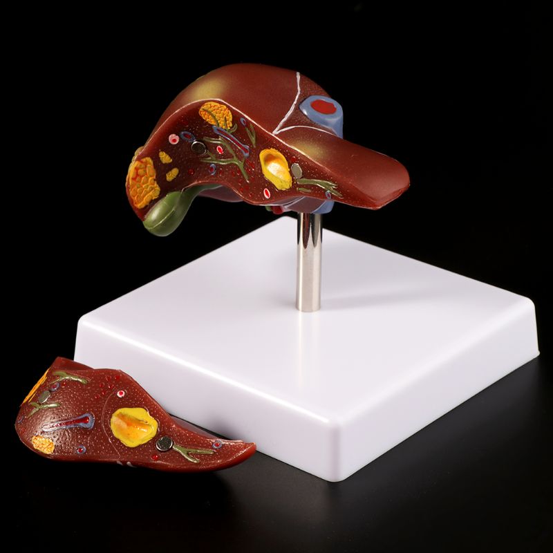Medical Lab Technology - Wątroby ludzkiej patologicznych anatomiczny Model anatomii